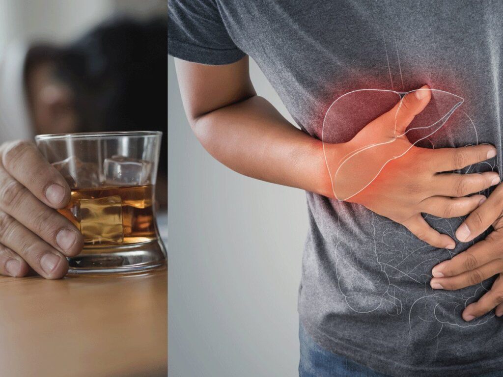 alcohol-liver-disease